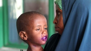 Hahó, világ!!! Több tízezer gyermek éhezik Szomáliában