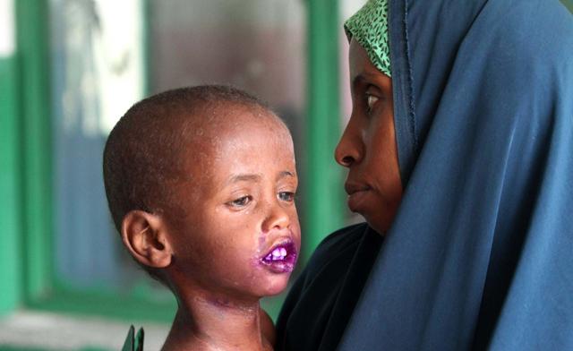 Hahó, világ!!! Több tízezer gyermek éhezik Szomáliában