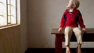 Rituális gyilkosság áldozata lehetett egy albínó kislány