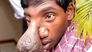 Teniszlabda nagyságú agysérvet távolítottak el egy indiai fiú fejéről