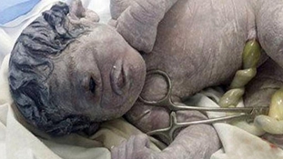 Küklopsz-csecsemő született Egyiptomban