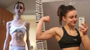 Anorexia előtt és után: egy lány az Instagramon számol be küzdelméről