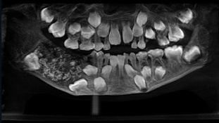 Több, mint 500 fogat műtöttek ki egy indiai fiú szájából